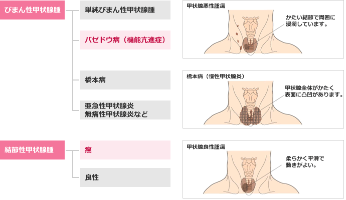 甲状腺の病気と種類の表